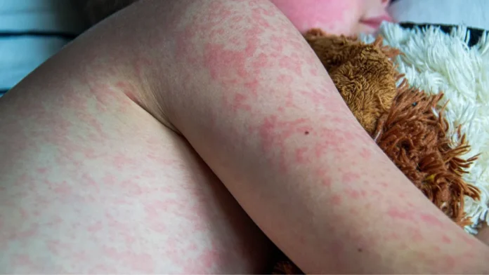 discurso antivacunas