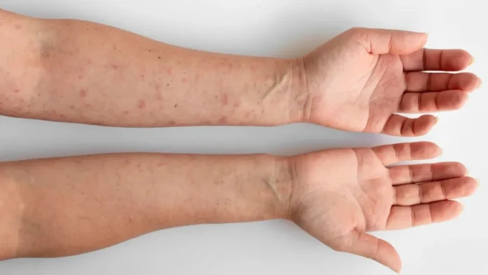 aumento de casos de sífilis