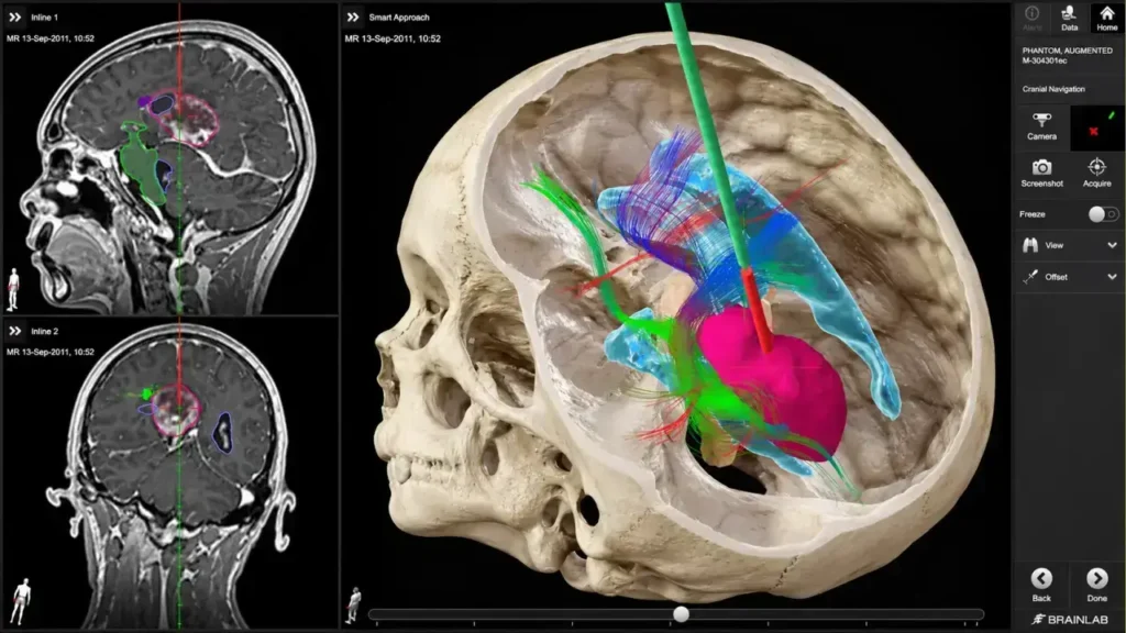 Representa la calibración del sistema de neuronavegación ("GPS quirúrgico"), donde los cirujanos proyectan la trayectoria exacta hacia la base del cráneo sobre la reconstrucción digital del cerebro de la paciente, logrando delimitar los márgenes del tumor y trazar una ruta de acceso que respete vasos sanguíneos y áreas funcionales críticas.