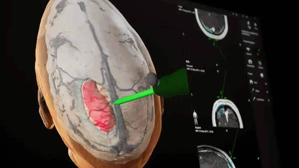 El equipo quirúrgico introduce instrumental de microcirugía y endoscopios de alta definición (habitualmente por vía transnasal o transorbitaria), logrando alcanzar, diseccionar y extirpar la masa tumoral alojada en la base del cráneo a través de orificios naturales, evitando por completo una craneotomía abierta y reduciendo el riesgo de secuelas neurológicas.